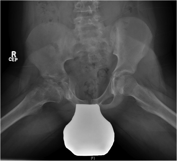 Perthes Stuhlberg Class IV lateral